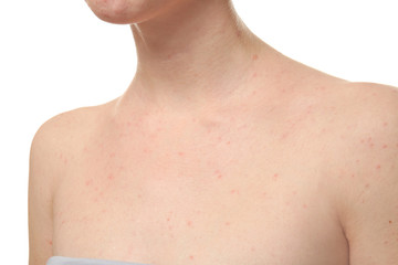 Young woman with problem skin on white background, closeup