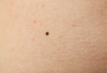 Human skin with birthmark, closeup