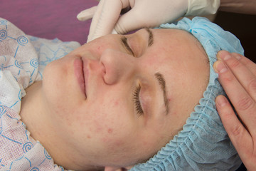 Fototapeta na wymiar Professional acne facial cleansing in the cabin