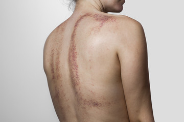 Rear view of a woman with bruises on white background.