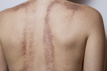Fototapeta premium Rear view of a woman with bruises on white background.
