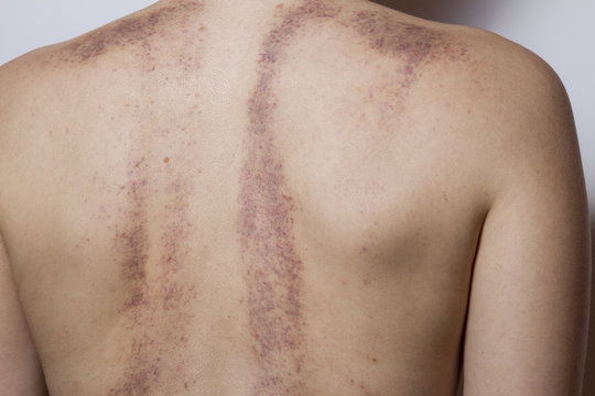 Rear view of a woman with bruises on white background.