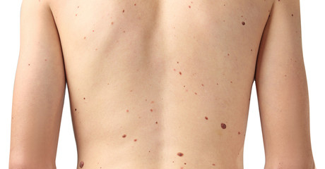Young man with birthmarks on light background, closeup