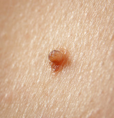 Human skin with birthmark, closeup