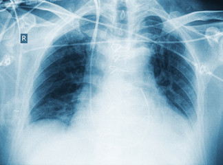 X-ray of patient after surgery with pneumonia