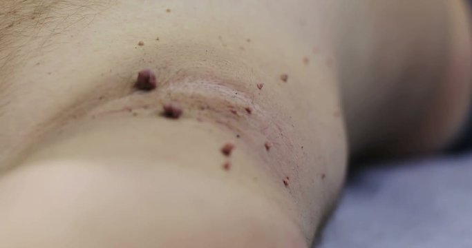 Close up of a lot of of papillomas on a male body.