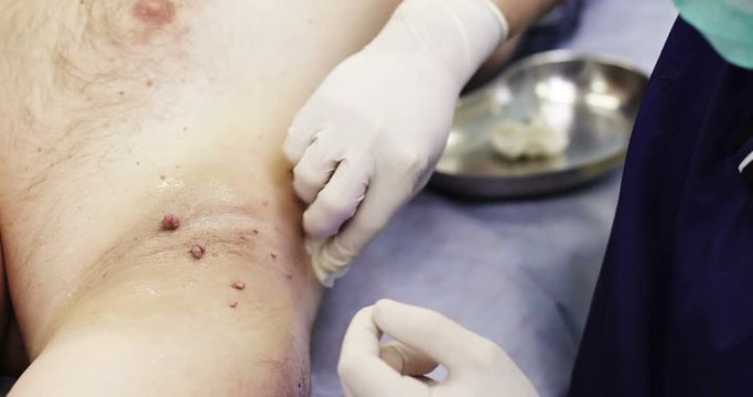 4K The doctor disinfects the armpits with papillomas.