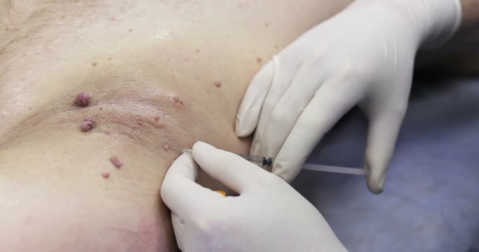 4K Armpits is with papillomas.
