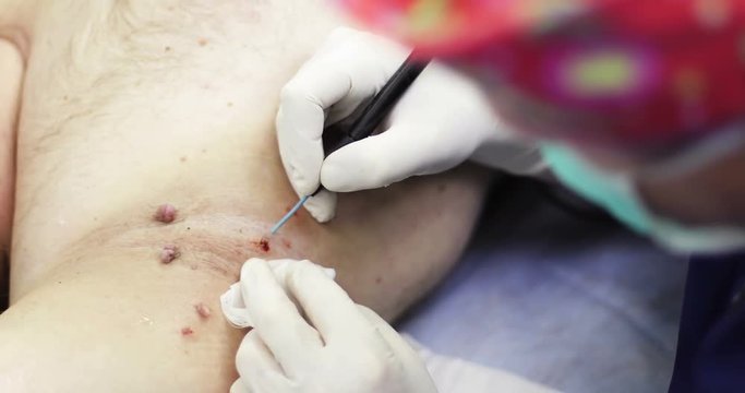 4K Close up. Electrocoagulation of papillomas.