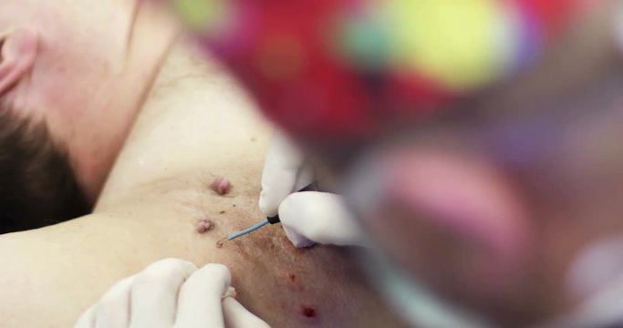 4K Close up Electrocoagulation of papillomas.