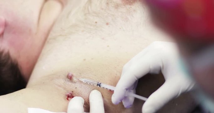 4K Electrocoagulation of papillomas.