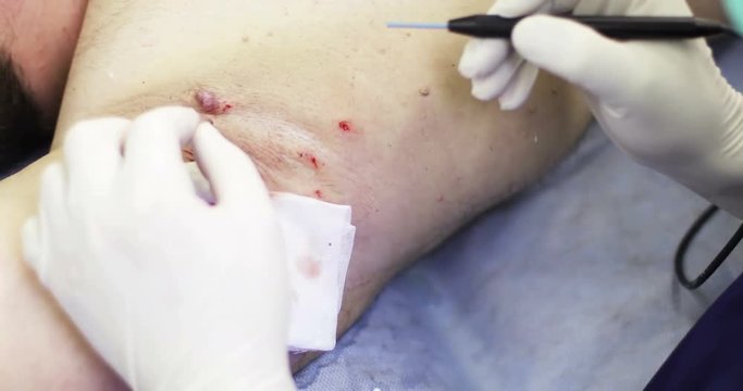 4K Plastic surgery. Close up Electrocoagulation of papillomas.