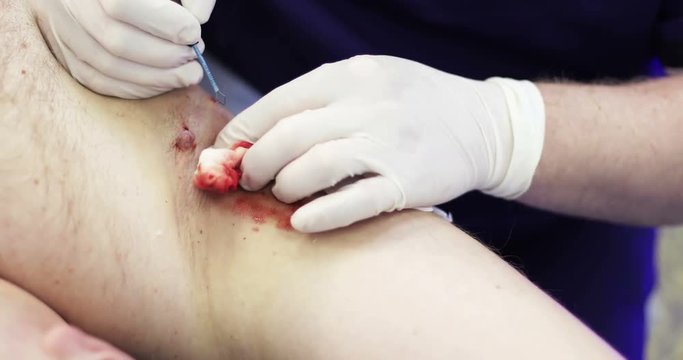 4K Cosmetic Surgery. Bleeding.