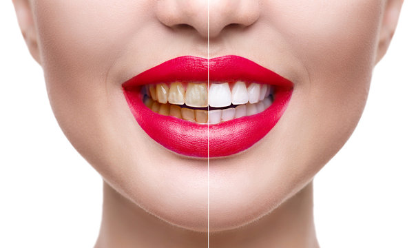 Woman teeth before and after whitening. Dental health concept. Oral care