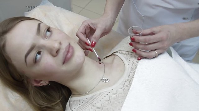 nevus removal by laser