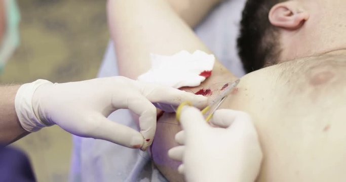 4K Electrocoagulation of papillomas. Plastic surgery.