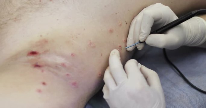 4K Plastic surgery. Doctor in medical gloves burns papillomavirus on the body.