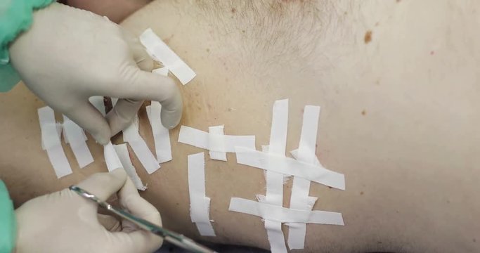 4K Electrocoagulation of papillomas.
