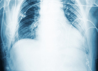 X-ray scan of patient`s chest after surgery