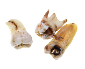 Patients extracted teeth on a white background