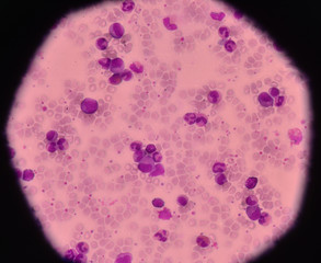 Leukemia blood cells medical science background concept.