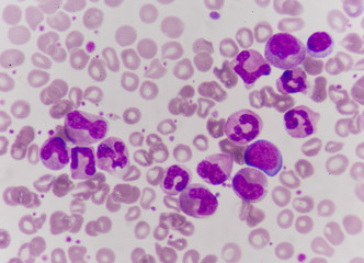 Leukemia blood cells medical science background concept.