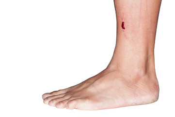 Unidentified man left leg with blood on leg, clipping path included. - obrazy, fototapety, plakaty