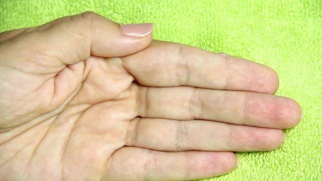 Caucasian woman finishes applying medicine to wart on her index finger. Close up of female hand. Real time full hd video footage.
