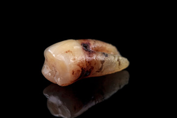 The remote tooth is damaged by caries on a black background. Macro.