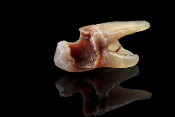 The remote tooth is damaged by caries on a black background. Macro.