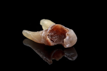 The remote tooth is damaged by caries on a black background. Macro.
