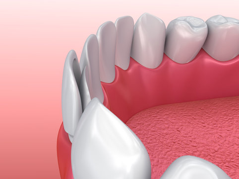 Dental Veneers: Porcelain Veneer installation Procedure. 3d illustration