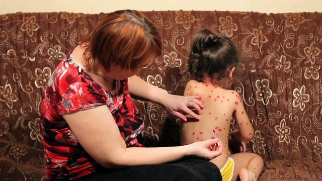 Woman looks for and smears a chicken pox eruption on a back of the little girl. House treatment.