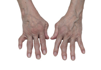 arthritis of the hands in elderly women