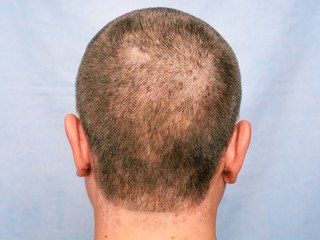 Seborrheic dermatitis. inflammatory changes of the skin.