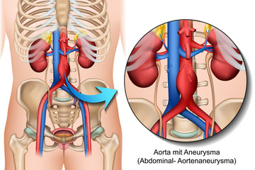 Anatomie Bauchaortenaneurysma, Abdominales Aortenaneurysma illustration - obrazy, fototapety, plakaty