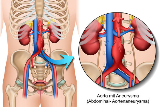 Anatomie Bauchaortenaneurysma, Abdominales Aortenaneurysma illustration