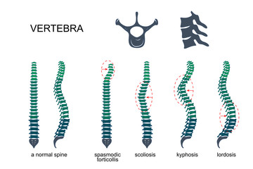 diseases of the spine