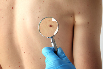 Dermatologist with magnifier examining patient in clinic, closeup