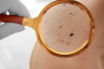 Dermatologist looking at patient's birthmarks through magnifier, closeup