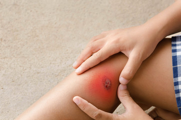 Child injured. Close up wound on child leg. Mother dressing child's leg