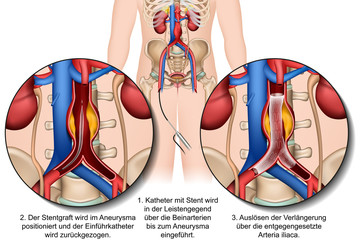Endovaskuläre Therapie des Bauchaortenaneurysmas, vektor illustration