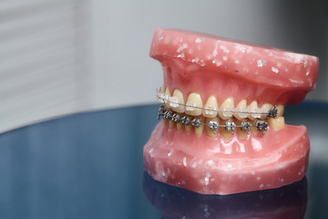 Human jaw or teeth model with metal wired dental braces