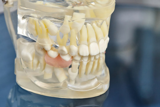Human teeth orthodontic dental model with implants, dental braces