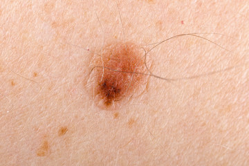 Nevus on human skin