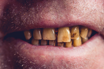 Yellow and curved teeth of a smoker covered with dental stone