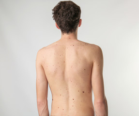 Fototapeta premium Young man with birthmarks on light background