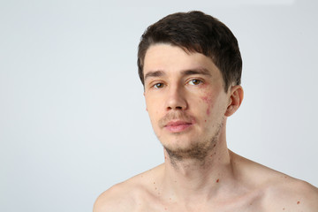 Obraz premium Young man with birthmarks on light background