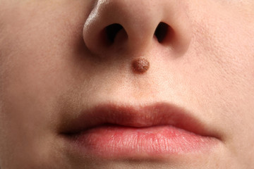 Birthmark on young woman's face, closeup