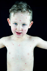Caucasian boy with chickenpox infection, rash and blisters. Portrait studio shot with black...